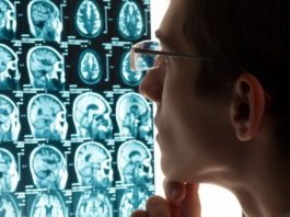 Causas y prevención del Ictus