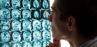 Causas y prevención del Ictus