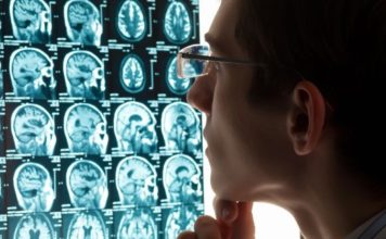 Causas y prevención del Ictus