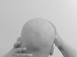 Juliana muestra foto de su cabeza si cabello por la quimioterapia