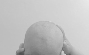 Juliana muestra foto de su cabeza si cabello por la quimioterapia