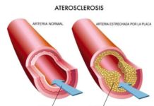 ¿Qué es la Arteroesclerosis?