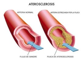 ¿Qué es la Arteroesclerosis?