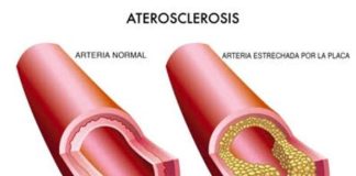 ¿Qué es la Arteroesclerosis?