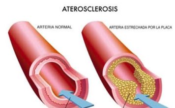 ¿Qué es la Arteroesclerosis?