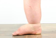 Conoce sobre la Filariasis o Elefantiasis