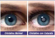 La Catarata: síntomas y como se previene
