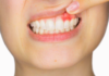 Conoce sobre la Gingivitis, síntomas, causas y prevención