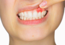 Conoce sobre la Gingivitis, síntomas, causas y prevención