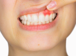 Conoce sobre la Gingivitis, síntomas, causas y prevención
