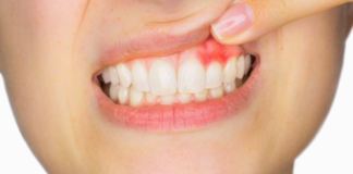 Conoce sobre la Gingivitis, síntomas, causas y prevención