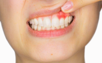 Conoce sobre la Gingivitis, síntomas, causas y prevención