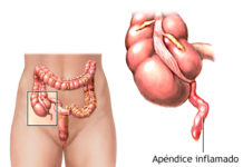 Apendicitis: causas y síntomas