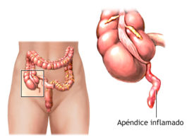 Apendicitis: causas y síntomas
