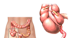 Apendicitis: causas y síntomas