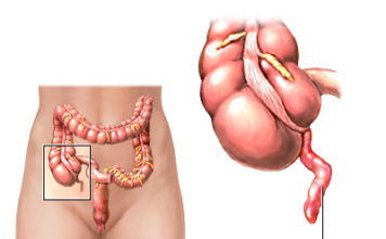 Apendicitis: causas y síntomas