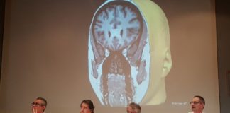 Primera cirugía láser en España para tratar la epilepsia y tumores cerebrales