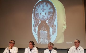 Primera cirugía láser en España para tratar la epilepsia y tumores cerebrales