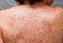 Médicos de Santiago enfrentan la presencia del “Kawasaki”