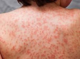 Médicos de Santiago enfrentan la presencia del “Kawasaki”