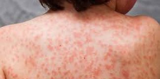 Médicos de Santiago enfrentan la presencia del “Kawasaki”