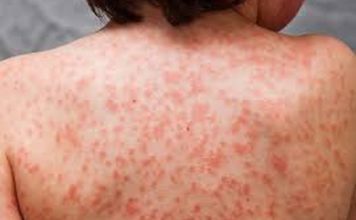 Médicos de Santiago enfrentan la presencia del “Kawasaki”