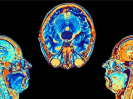 Covid: el estudio que muestra cómo cambia el cerebro tras una infección por coronavirus, aunque esta sea leve