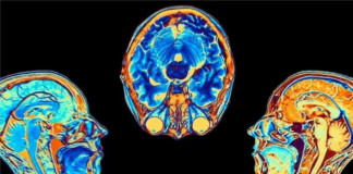 Covid: el estudio que muestra cómo cambia el cerebro tras una infección por coronavirus, aunque esta sea leve