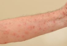 Ministro de Salud: enfermedad cutánea reportada en Haití es de fácil curación y RD no tiene casos