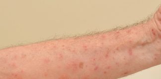 Ministro de Salud: enfermedad cutánea reportada en Haití es de fácil curación y RD no tiene casos