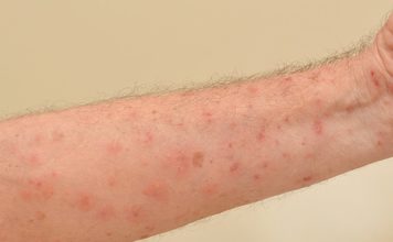 Ministro de Salud: enfermedad cutánea reportada en Haití es de fácil curación y RD no tiene casos