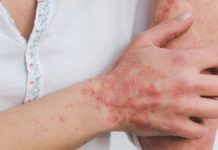 Higiene, elemento principal para evitar afección detectada en Haití