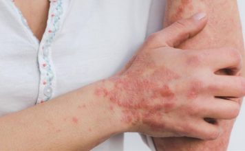 Higiene, elemento principal para evitar afección detectada en Haití