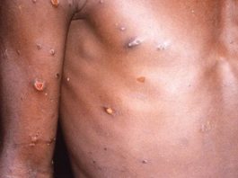 Salud Pública notifica a la población sospecha de Viruela Símica