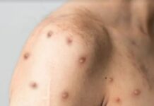 OMS mantiene alerta internacional por viruela del mono pese a bajada en casos