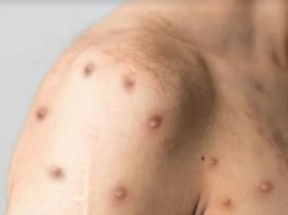 OMS mantiene alerta internacional por viruela del mono pese a bajada en casos