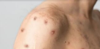 OMS mantiene alerta internacional por viruela del mono pese a bajada en casos