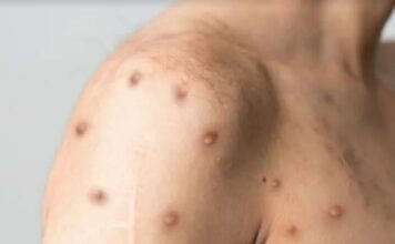 OMS mantiene alerta internacional por viruela del mono pese a bajada en casos